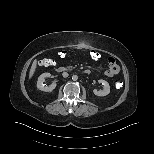 File:Buried bumper syndrome - gastrostomy tube (Radiopaedia 63843-72575 Axial Inject 16).jpg