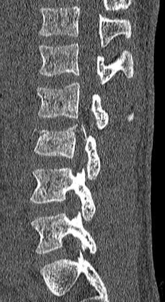 Burst fracture (Radiopaedia 53373-59357 Sagittal bone window 24).jpg