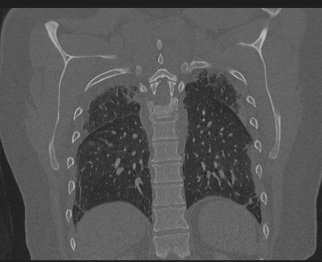 Burst fracture - thoracic spine (Radiopaedia 30238-30865 Coronal bone window 122).jpg