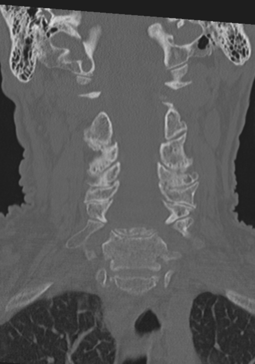 C2 fracture with vertebral artery dissection (Radiopaedia 37378-39199 Coronal bone window 23).png