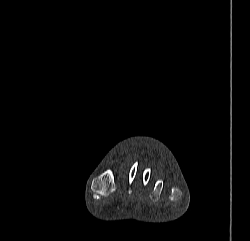 File:Calcaneal fracture - Sanders type 4 (Radiopaedia 90179-107370 Coronal bone window 27).jpg