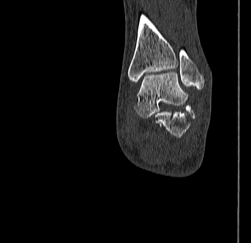 Calcaneal fracture - Sanders type 4 (Radiopaedia 90179-107370 Coronal bone window 65).jpg
