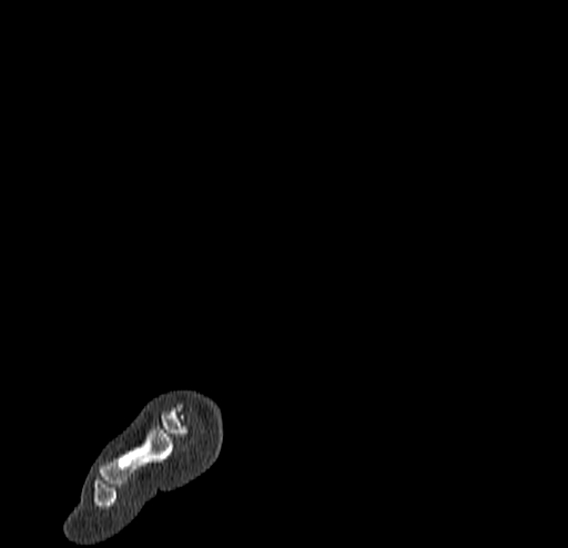 File:Calcaneal fracture - Sanders type 4 (Radiopaedia 90179-107370 Sagittal bone window 5).jpg