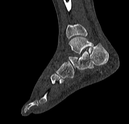 Calcaneal fracture - Sanders type 4 (Radiopaedia 90179-107370 Sagittal bone window 58).jpg