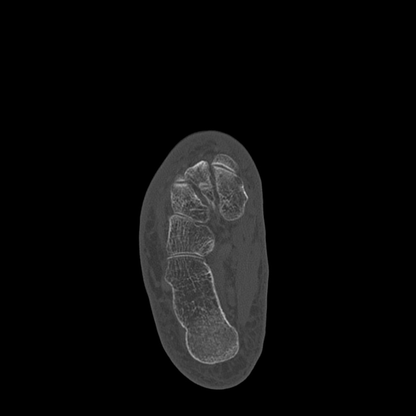 Calcaneal tuberosity avulsion fracture (Radiopaedia 22649-22668 Axial bone window 31).jpg