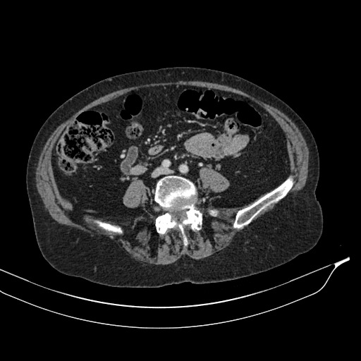 Calcified adrenal glands and Spigelian hernia (Radiopaedia 49741-54988 A 139).jpg