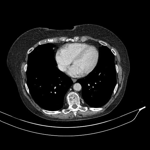 Calcified adrenal glands and Spigelian hernia (Radiopaedia 49741-54988 A 3).jpg