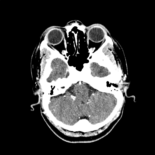 File:Calcified cerebral hydatid cyst (Radiopaedia 65603-74717 Axial with contrast 10).jpg