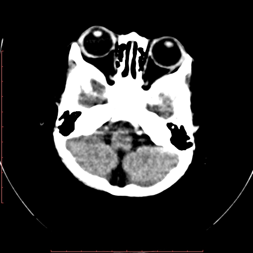 File:Calcified middle cerebral artery embolism (Radiopaedia 78949-91860 Axial non-contrast 5).jpg