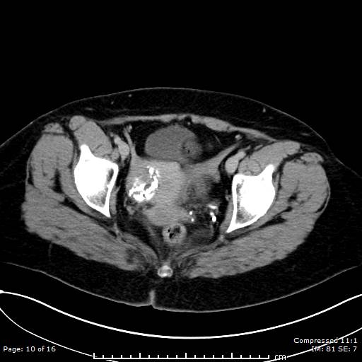 File:Calcified uterine fibroid (Radiopaedia 56077-62759 Axial C+ delayed 10).jpg
