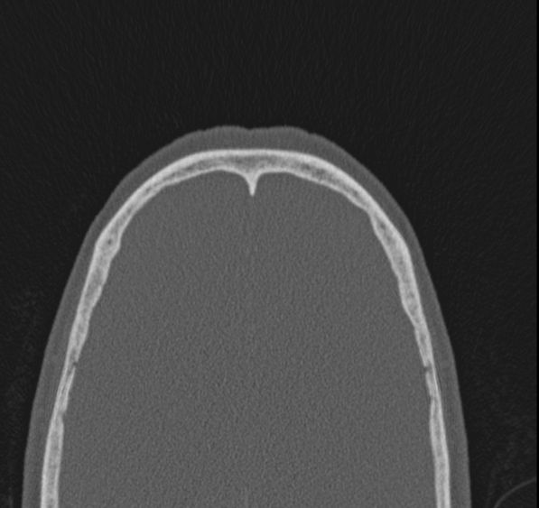 Caldwell-Luc operation (Radiopaedia 52329-58225 Axial bone window 6).jpg