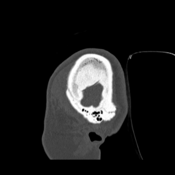 Calvarial osteoma (Radiopaedia 36520-38079 Sagittal bone window 10).jpg