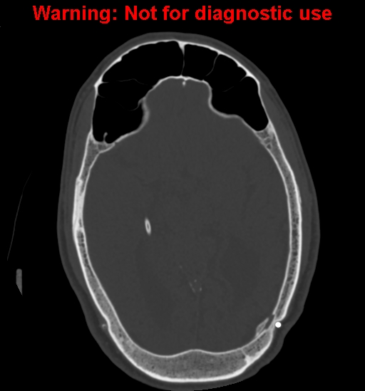 File:Calvarial thickening from chronic shunting (Radiopaedia 60079-67637 Axial bone window 86).jpg