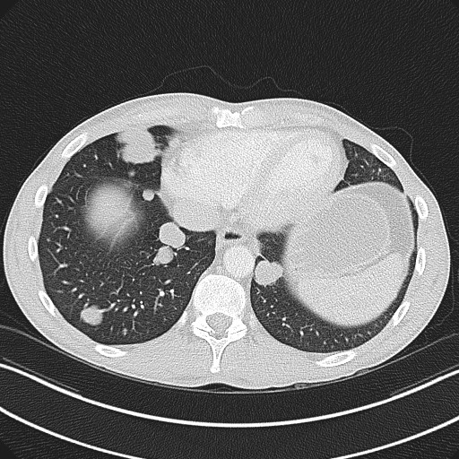Cannonball metastases - testicular choriocarcinoma (Radiopaedia 84510-99891 Axial lung window 75).jpg