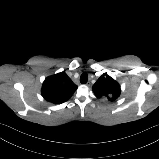 Cannonball metastases - testicular choriocarcinoma (Radiopaedia 84510-99891 B 26).jpg