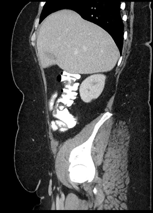 Carcinoid tumor - terminal ileum (Radiopaedia 60931-68739 C 79).jpg