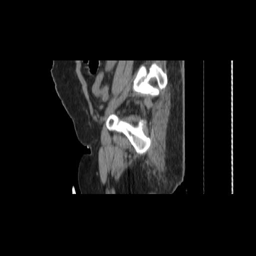 File:Carcinoma cervix- brachytherapy applicator (Radiopaedia 33135-34173 D 150).jpg