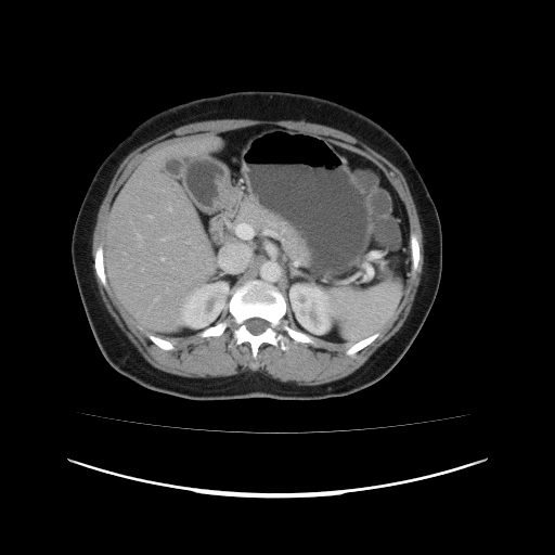 Carcinoma colon - hepatic flexure (Radiopaedia 19461-19493 A 40).jpg