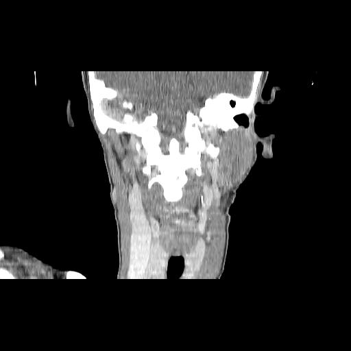 Carcinoma of the maxillary antrum (Radiopaedia 53805-59888 Coronal C+ delayed 106).jpg