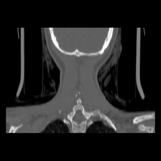 Carcinoma of the maxillary antrum (Radiopaedia 53805-59888 Coronal bone window 136).jpg