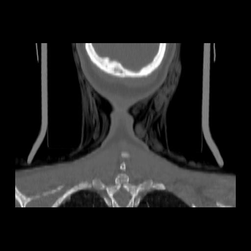 Carcinoma of the maxillary antrum (Radiopaedia 53805-59888 Coronal bone window 148).jpg