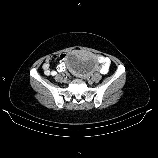 File:Carcinoma of uterine cervix (Radiopaedia 85861-101700 Axial C+ delayed 64).jpg