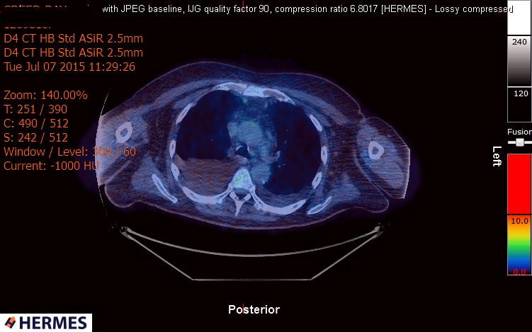 File:Cardiac lymphoma (Radiopaedia 38690-40871 Integrated PET-CT 4).jpg