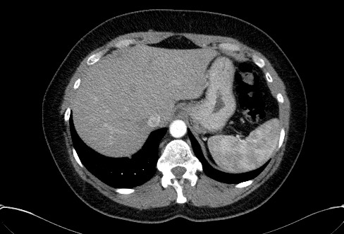File:Cardiac sarcoidosis (Radiopaedia 74548-85534 A 82).jpg