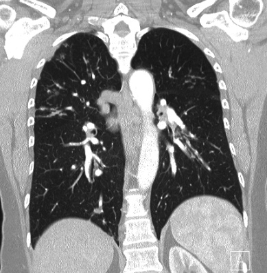 Cardiac sarcoidosis (Radiopaedia 74548-85534 Coronal lung window 44).jpg