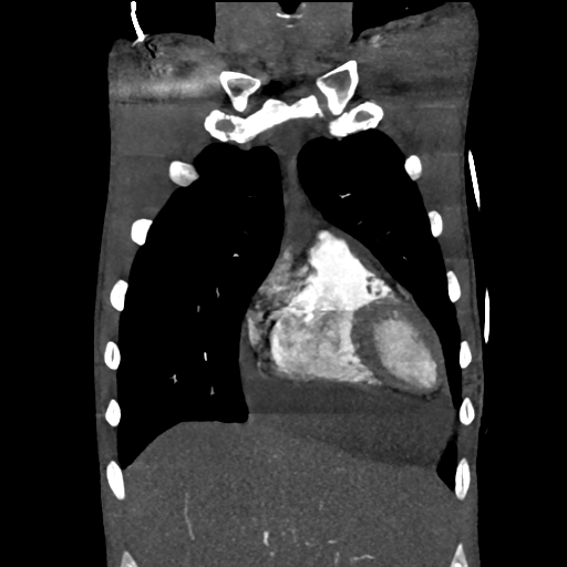 File:Cardiac tumor - undifferentiated pleomorphic sarcoma (Radiopaedia 45844-50134 Coronal non-contrast 15).png