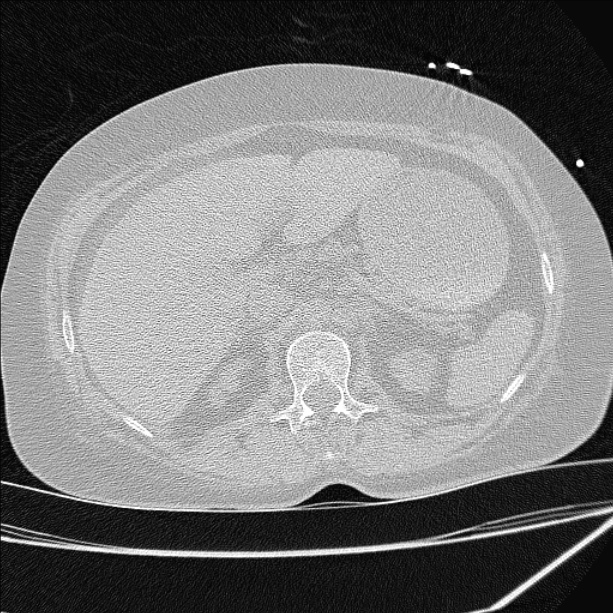 Cardiogenic pulmonary edema (Radiopaedia 29213-29609 Axial lung window 114).jpg