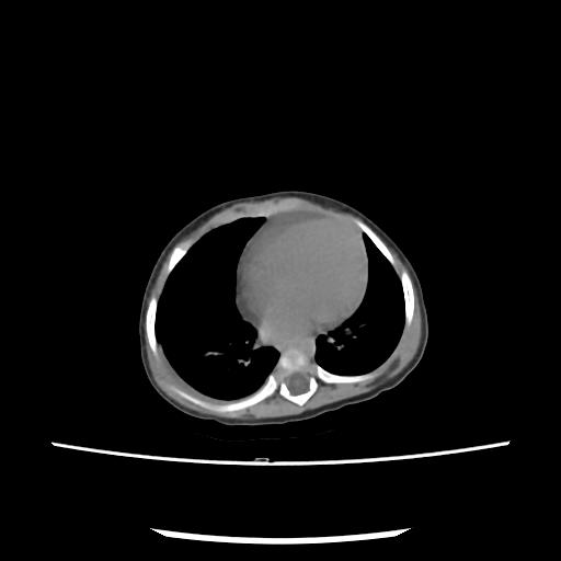 File:Caroli disease with autosomal recessive polycystic kidney disease (ARPKD) (Radiopaedia 89651-106703 E 2).jpg