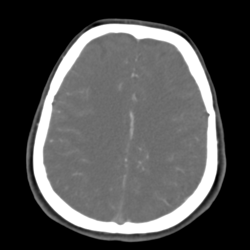 Carotico ophthalmic aneurysm (Radiopaedia 42916-46148 A 18).png