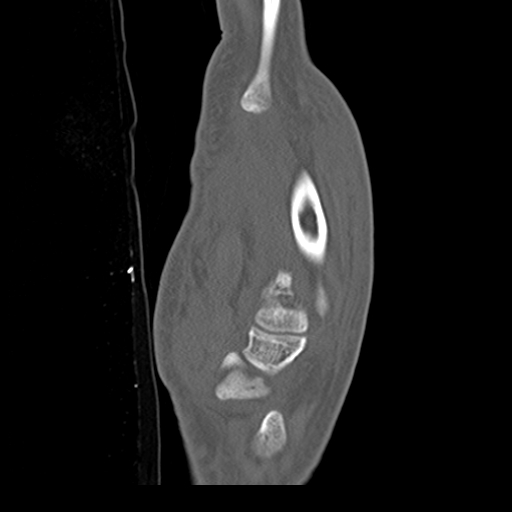 File:Carpo-metacarpal fracture-dislocations with hamatum split fracture (Radiopaedia 18482-18343 Sagittal bone window 20).jpg