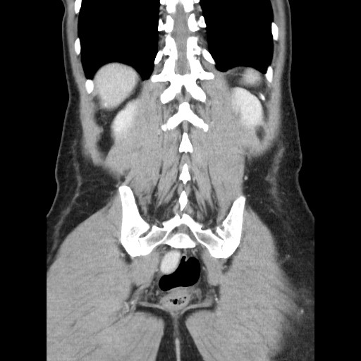 File:Castleman disease with fibrous pseudotumor in the abdomen (Radiopaedia 77296-89373 B 75).jpg