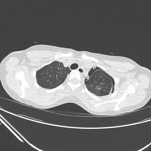 Catamenial pneumothorax (Radiopaedia 27946-28197 lung window 35).jpg