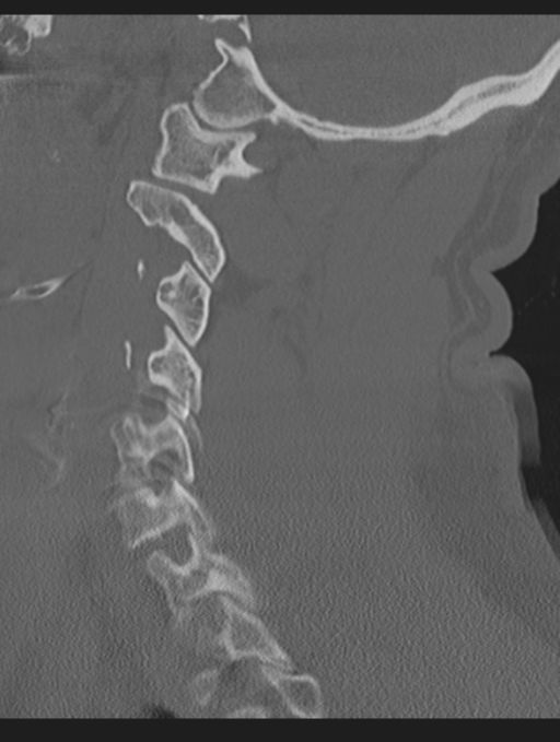 Cavernoma of cervical cord (Radiopaedia 50838-56346 Sagittal bone window 54).png