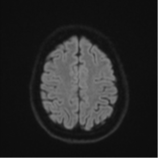 File:Cavernoma with bleed - midbrain (Radiopaedia 54546-60774 Axial DWI 49).png