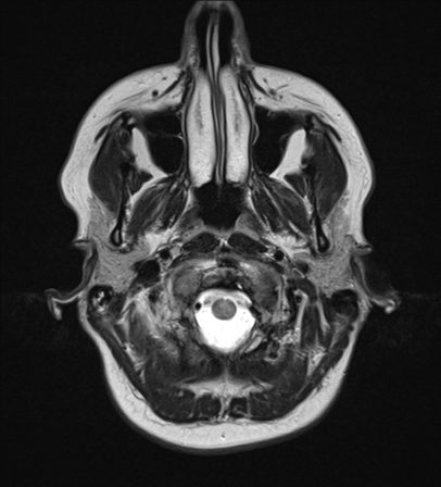 File:Cavernoma with bleed - midbrain (Radiopaedia 54546-60774 Axial T2 1).png