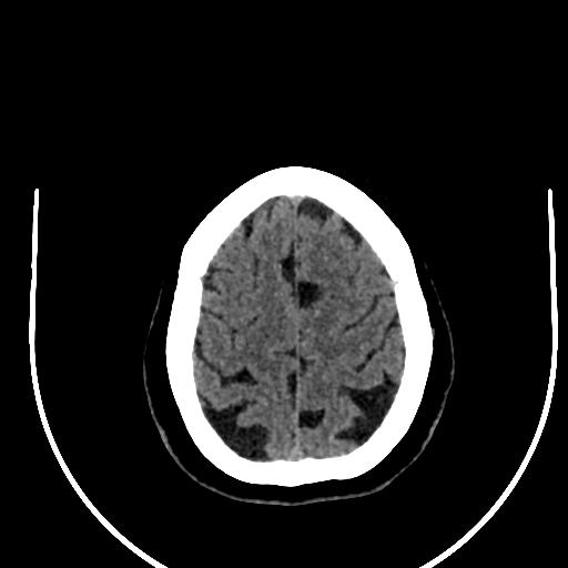 Cavernous hemangioma of the cerebellar falx (Radiopaedia 73025-83723 Axial non-contrast 115).jpg