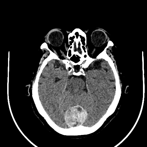 Cavernous hemangioma of the cerebellar falx (Radiopaedia 73025-83723 Axial non-contrast 48).jpg