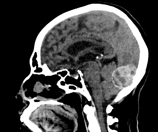 Cavernous hemangioma of the cerebellar falx (Radiopaedia 73025-83723 B 167).jpg