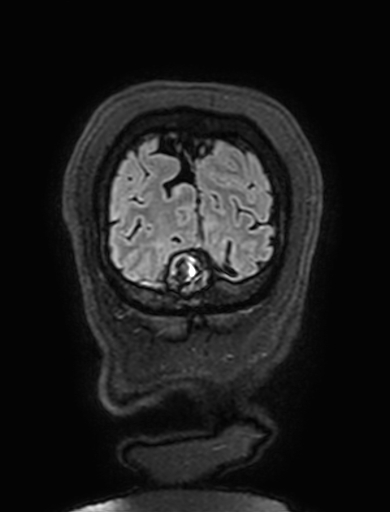 Cavernous hemangioma of the cerebellar falx (Radiopaedia 73025-83724 Coronal FLAIR 331).jpg