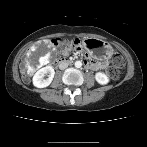 Cavernous hepatic hemangioma (Radiopaedia 75441-86667 B 59).jpg
