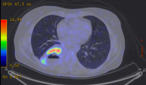 File:Cavitating lung mass - squamous cell carcinoma (Radiopaedia 48047-52853 A 56).png