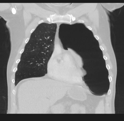 Cavitating pneumonia complicated by pneumothorax (Radiopaedia 48149-52994 Coronal lung window 19).png