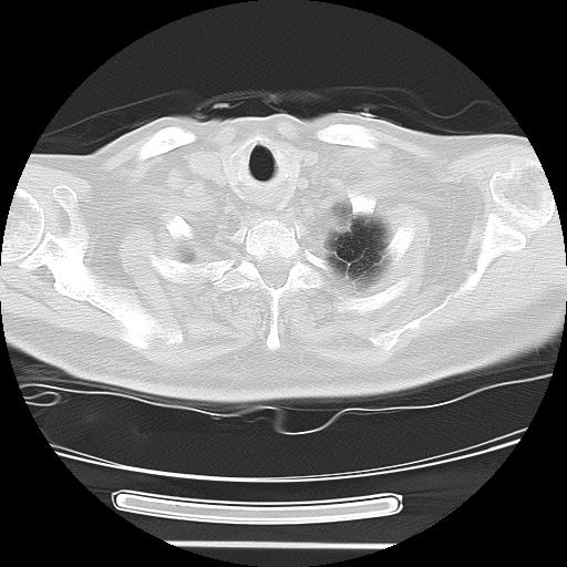 Cavitating pulmonary metastases (Radiopaedia 89545-106544 Axial lung window 3).jpg