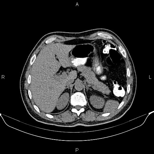 Cecal adenocarcinoma (Radiopaedia 85324-100916 Axial non-contrast 22).jpg