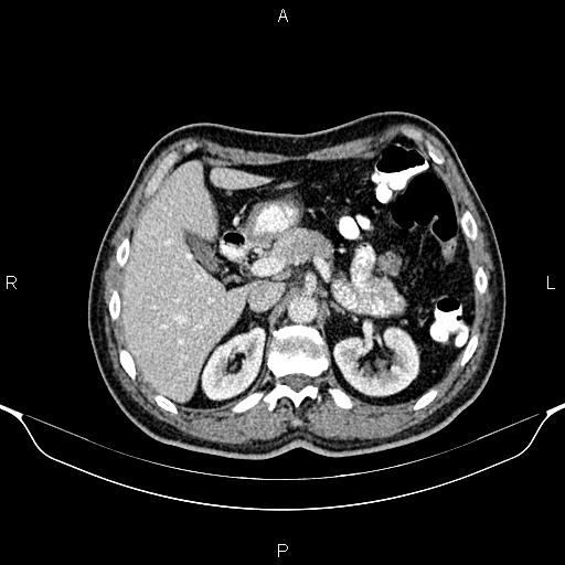 Cecal adenocarcinoma (Radiopaedia 85324-100916 B 27).jpg