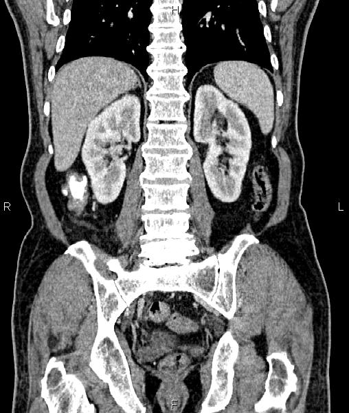 Cecal cancer with appendiceal mucocele (Radiopaedia 91080-108651 D 52).jpg